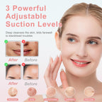 Pore Vacuum Blackhead Remover with 3 Adjustable Suction Levels, USB Rechargeable, 5 Replaceable Heads for Face Deep Cleansing, Includes Blackhead Spatula for Women & Men